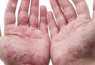 Hautkrankheit mit hohem Leidensdruck – Die Schuppenflechte